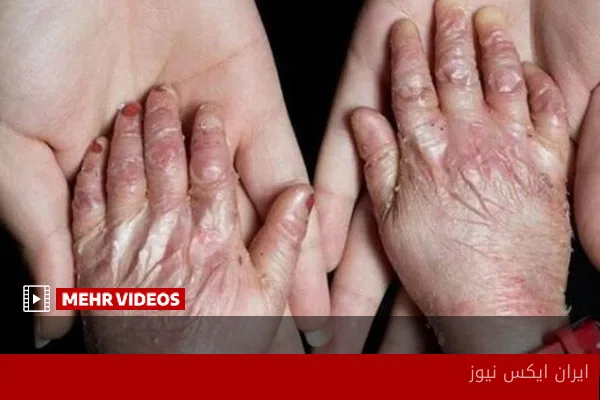 پرداخت خسارت به بیماران پروانه‌ای از اموال توقیف‌شده آمریکا