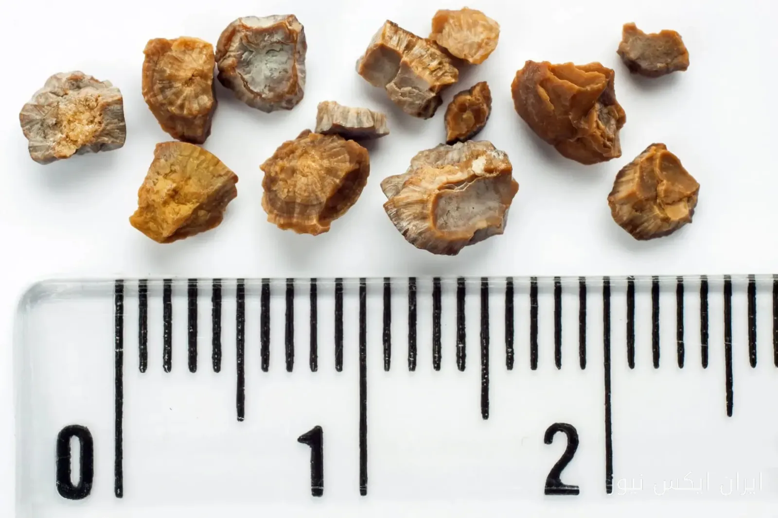 سنگ‌های بدن؛ از سنگ کلیه تا سنگ لوزه