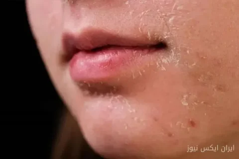 خشکی پوست صورت: دلایل و درمان‌های موثر