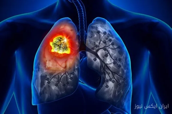 الميكروبلاستيكات المستنشقة في مرضى سرطان الرئة أكثر شيوعًا